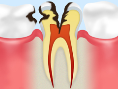 C3：神経にまで達した虫歯