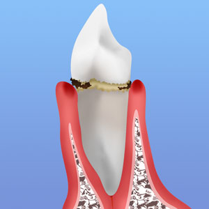 軽度歯周病（歯肉炎・軽度歯周炎）